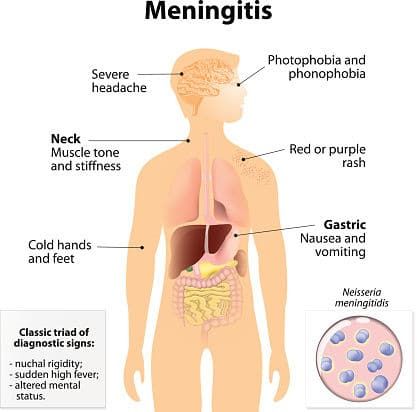 Failure to Diagnose Menin…