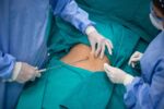 Understanding Liposuction Malpractice Claims.